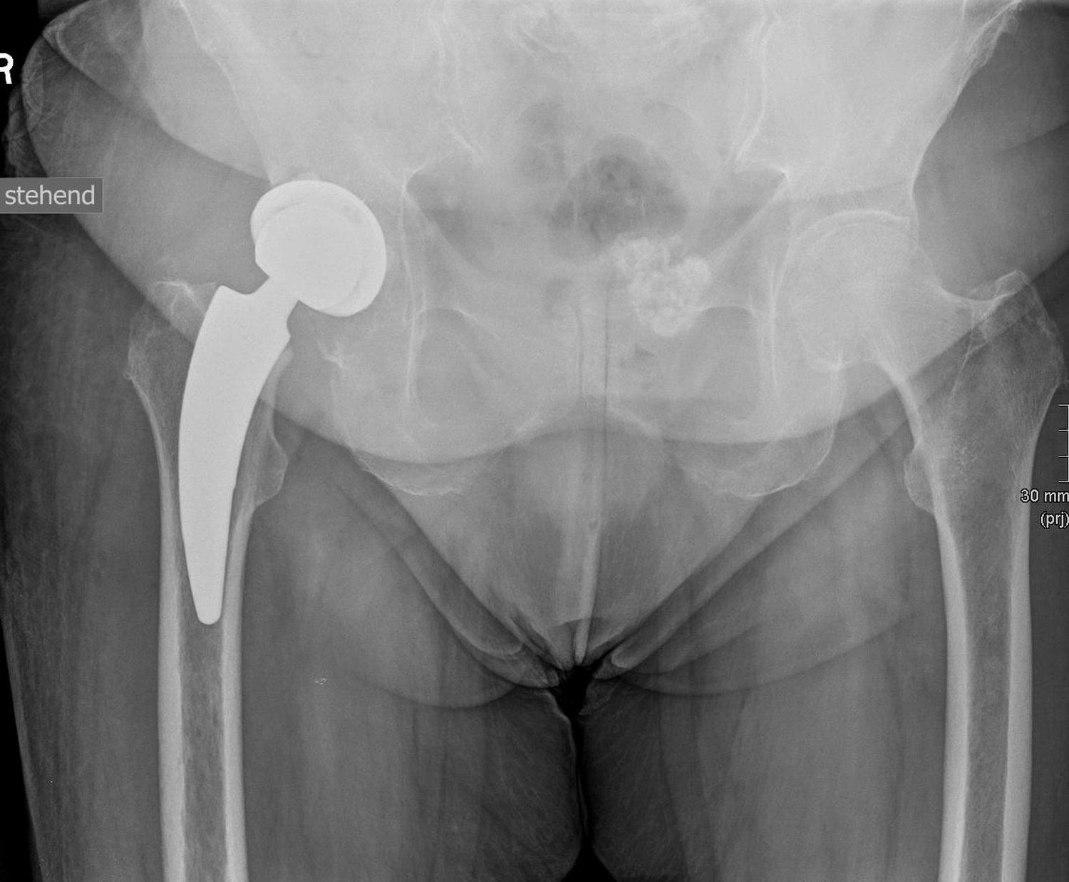 STENUM – Fachklinik für Orthopädie – Röntgenaufnahme der Hüfte mit Prothese auf der linken Seite