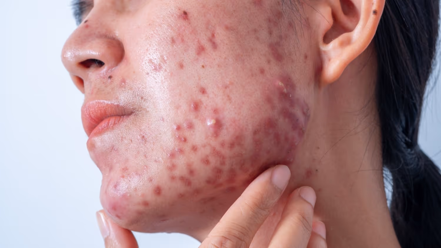 The Science Behind Hormonal Acne and Nutrition
