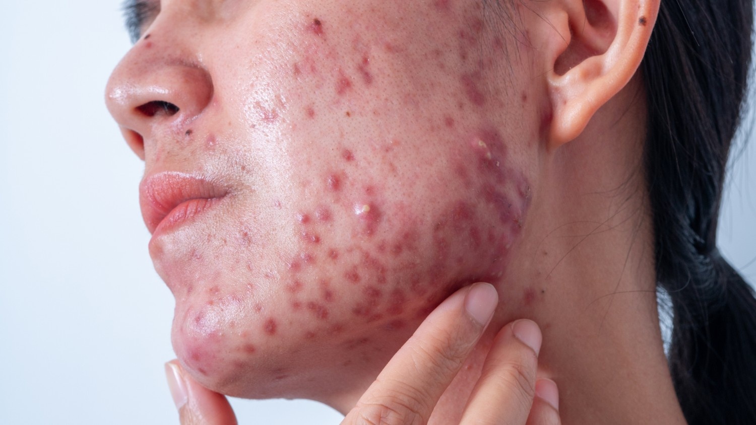 The Science Behind Hormonal Acne and Nutrition