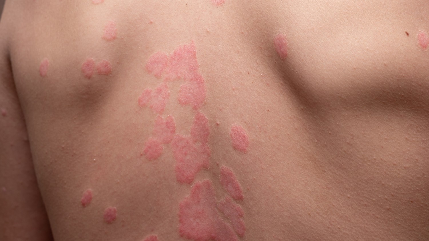 Sample Meal Plan for a Psoriasis Treatment Diet