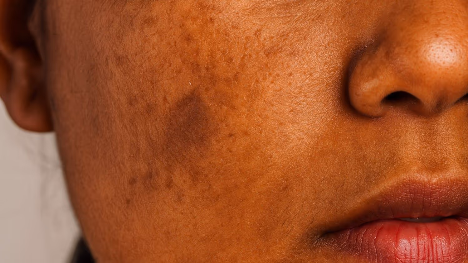 Pigmentation