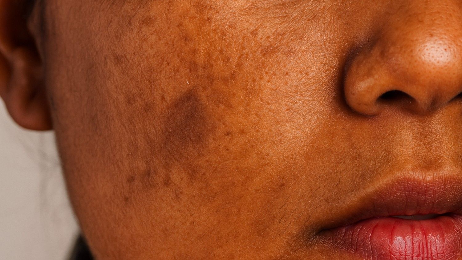 Pigmentation