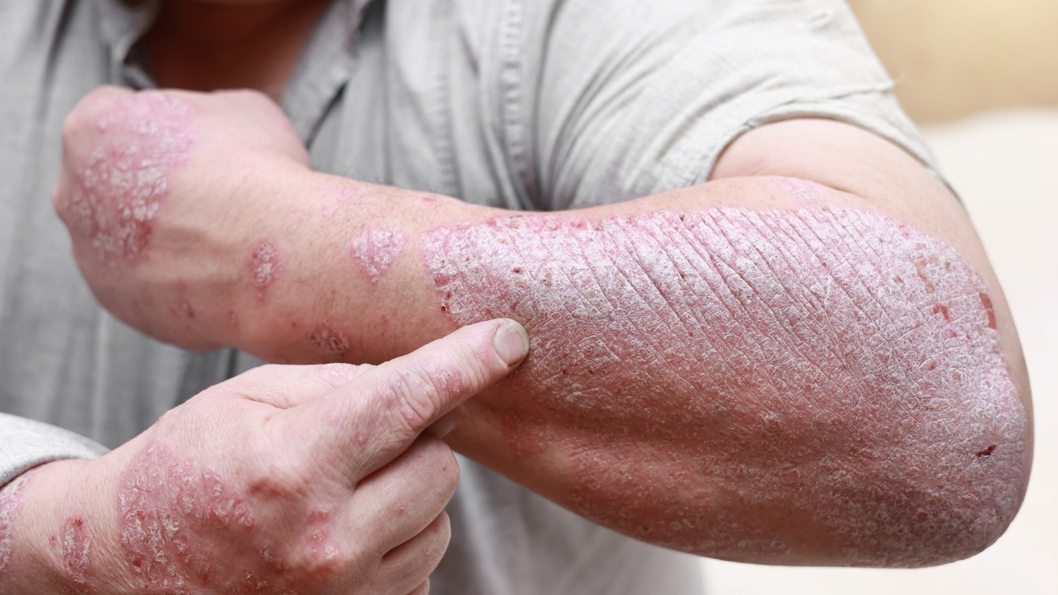 Diagnosis of Psoriasis