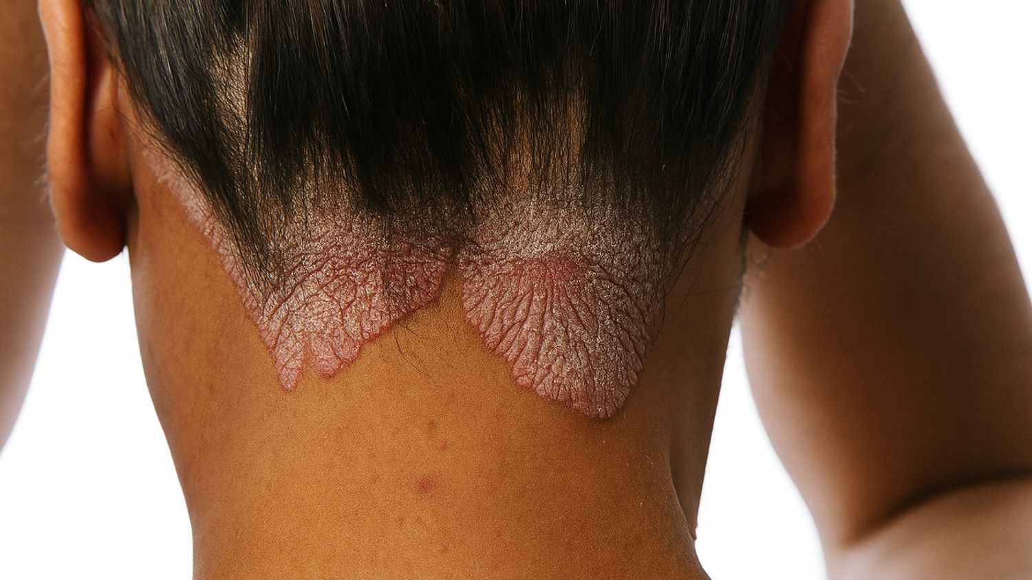 Scalp Psoriasis