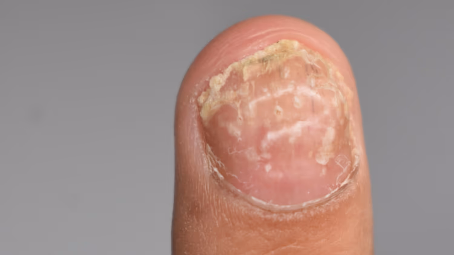 Nail Psoriasis