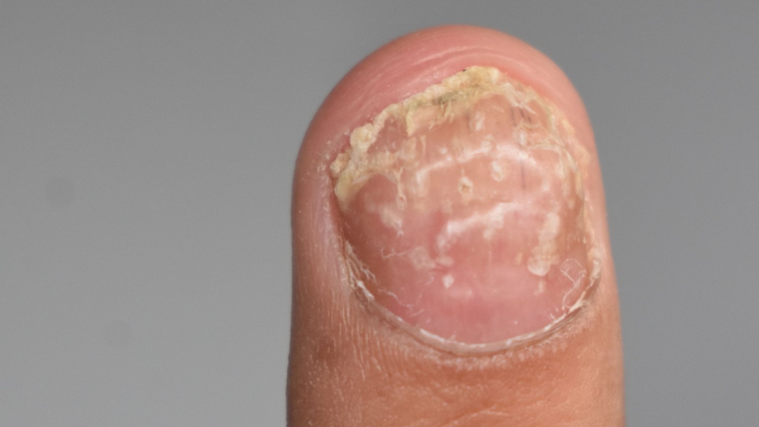 Nail Psoriasis