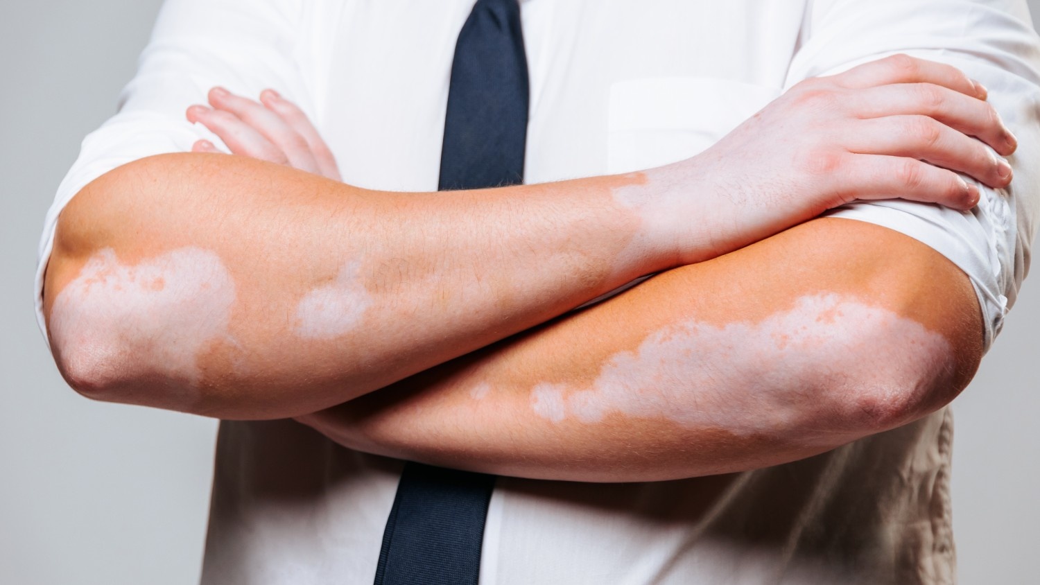 Common Symptoms and Types of Vitiligo