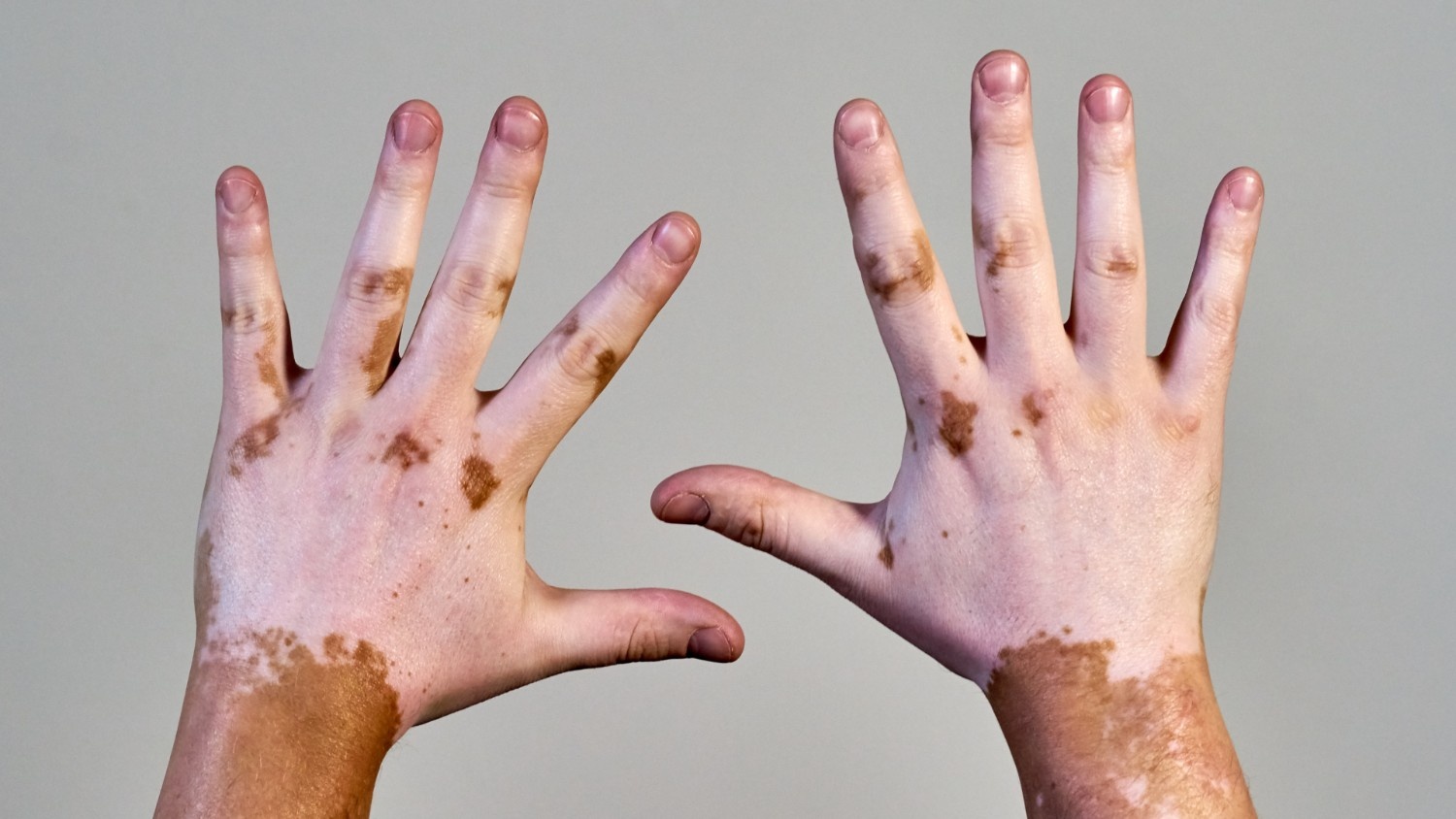 Causes and Risk Factors of Vitiligo