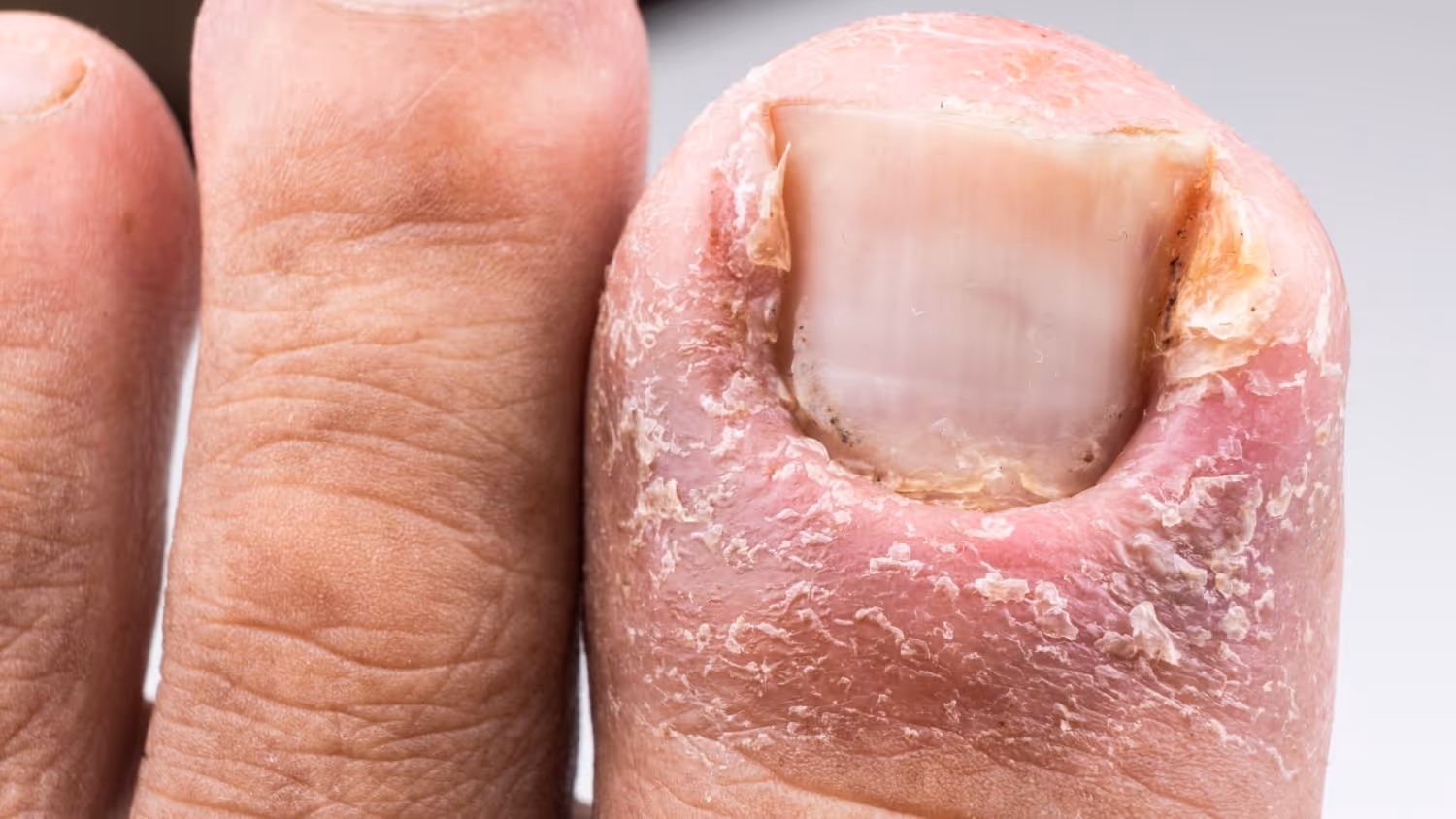 What Are Fungal Infections?