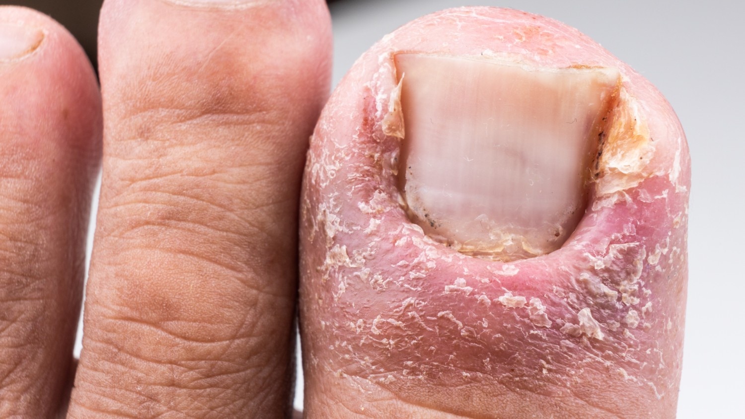 What Are Fungal Infections?