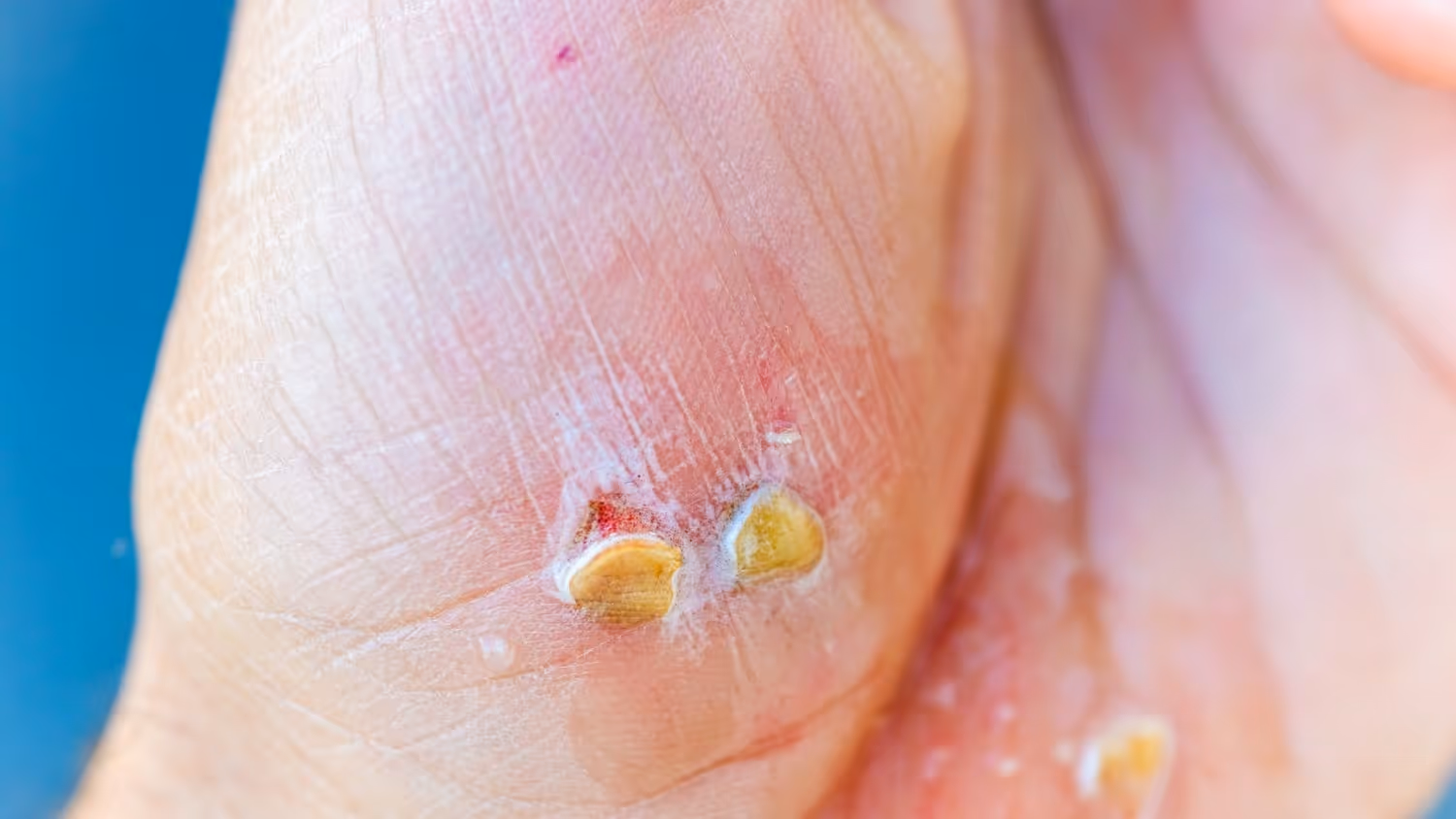 Causes and Risk Factors of Fungal Infections