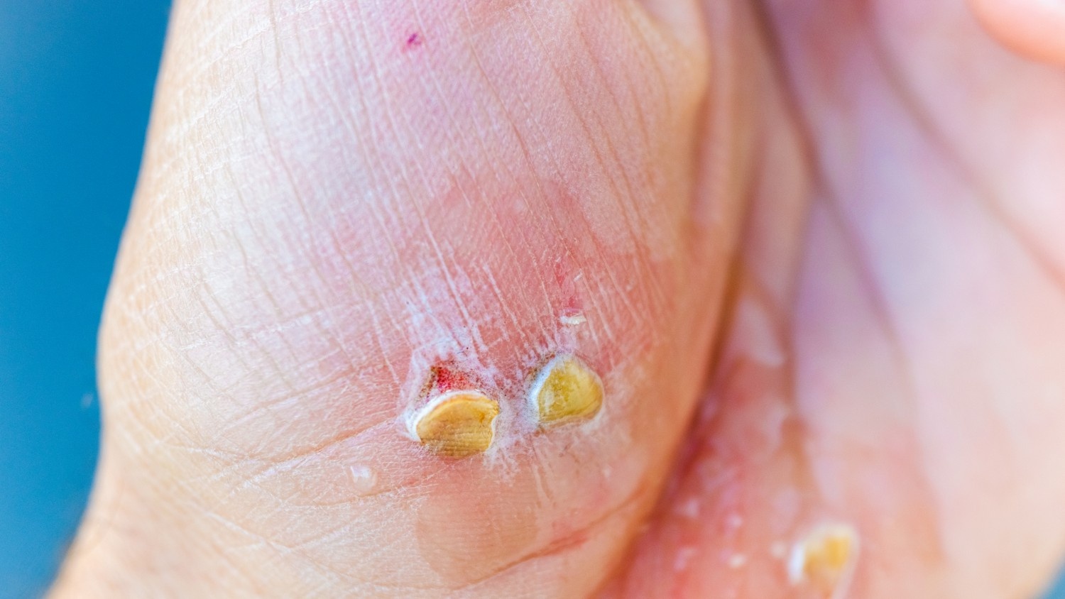 Causes and Risk Factors of Fungal Infections