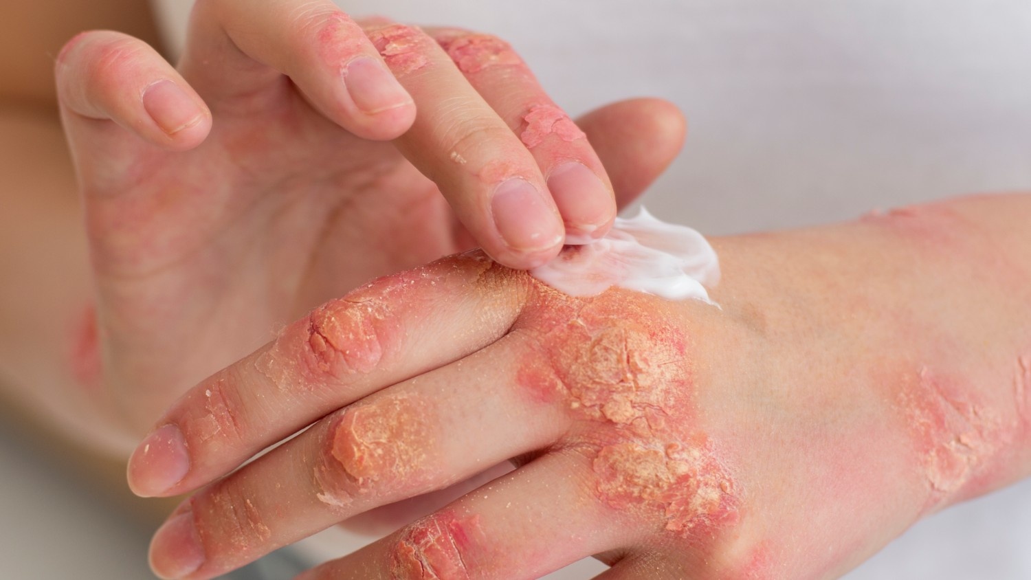 Diagnosis of Fungal Infections