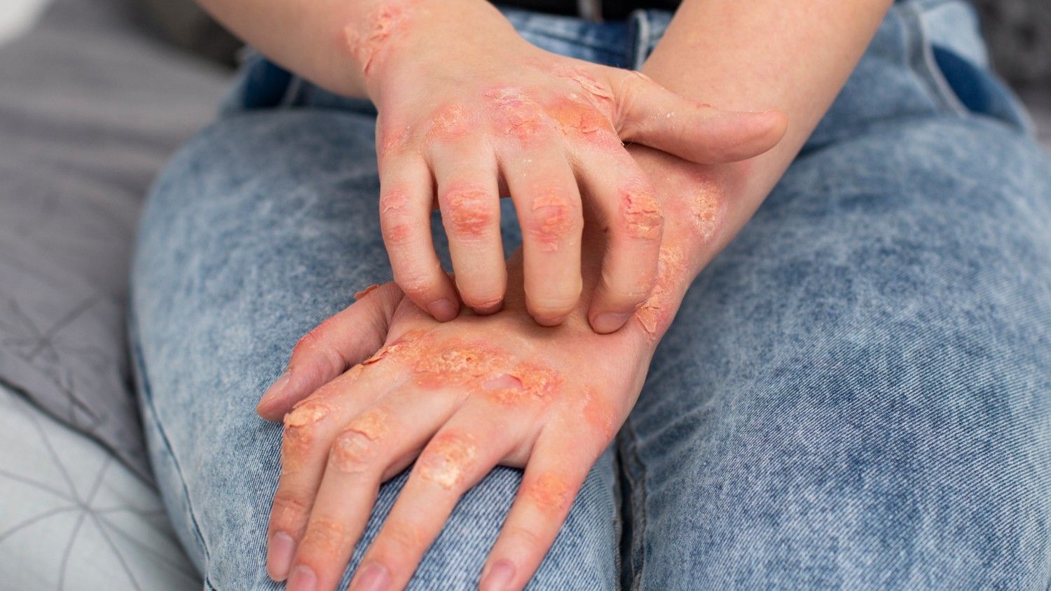 When to Seek Medical Help for Fungal Infections?