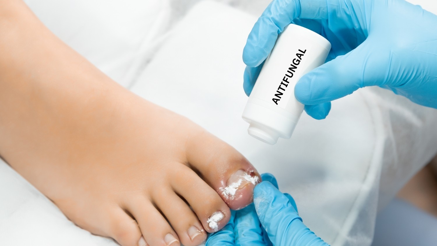 Prevention Strategies to Avoid Recurrence of Fungal Infections