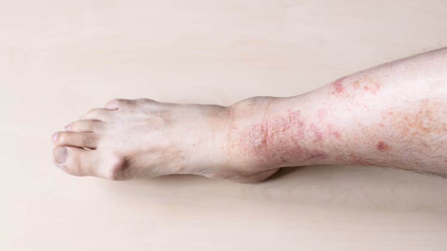 What is Eczema?