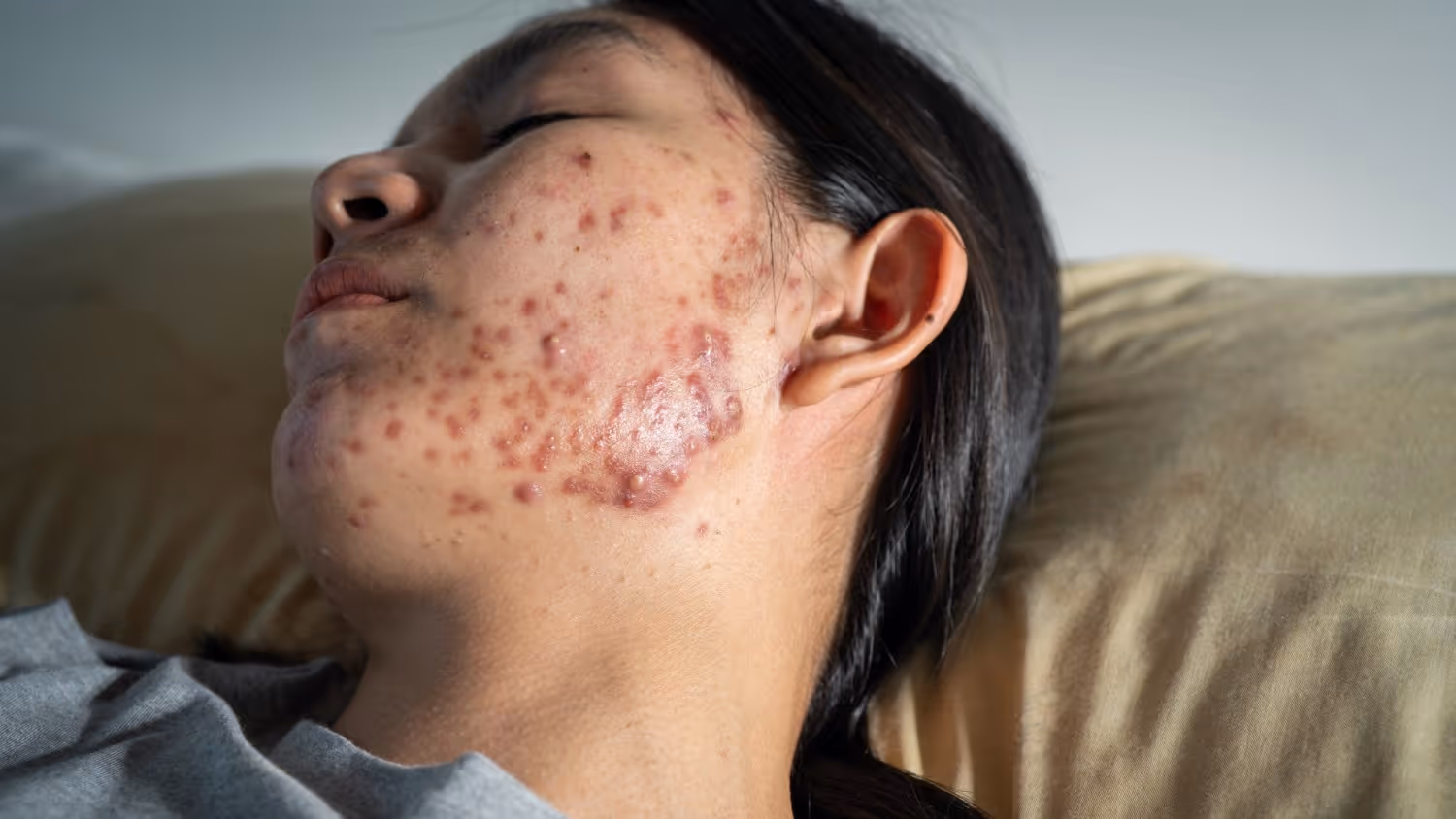 What is Acne Vulgaris?
