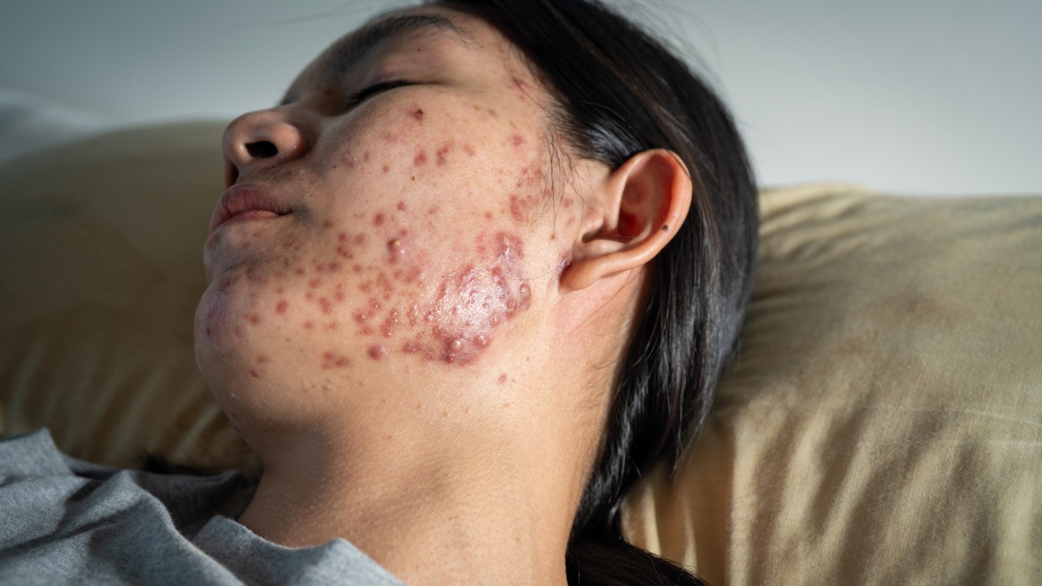 What is Acne Vulgaris?