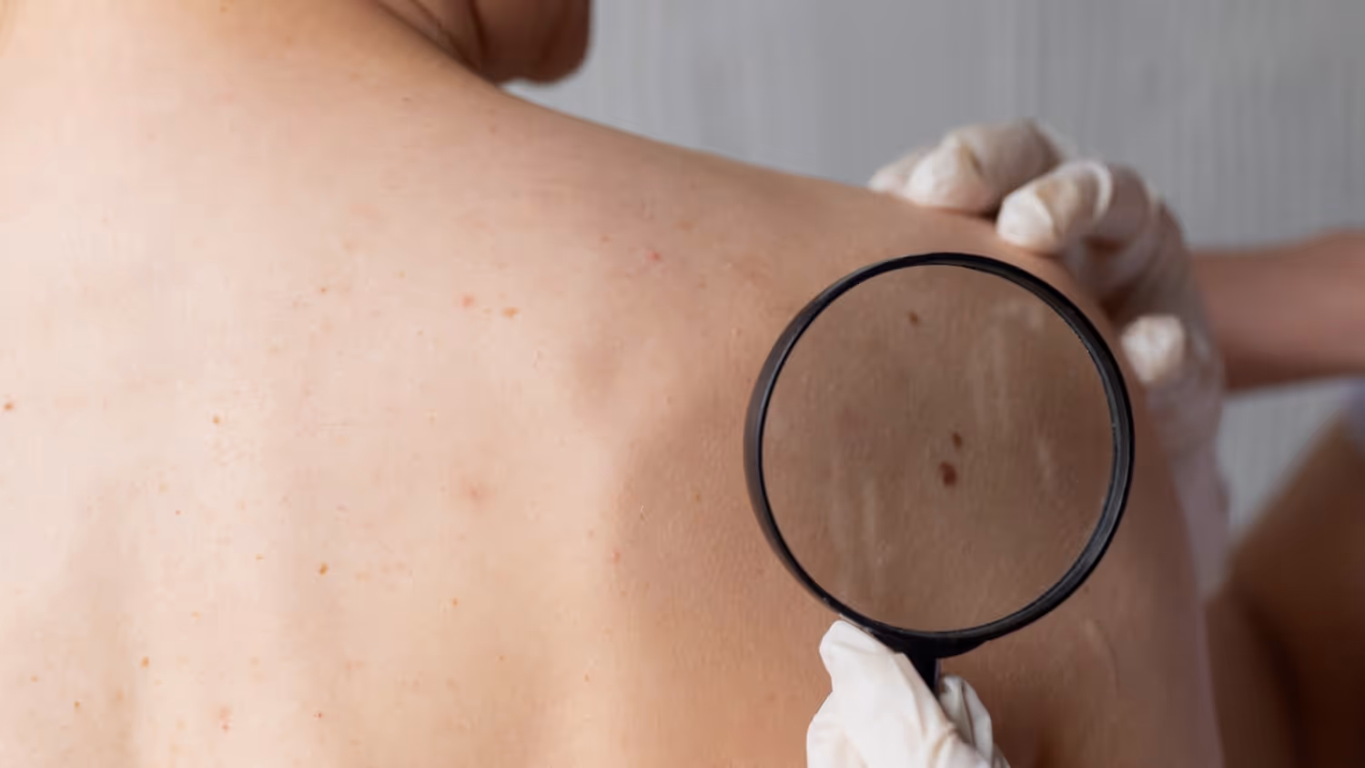 Methods of Mole Removal by a Dermatologist