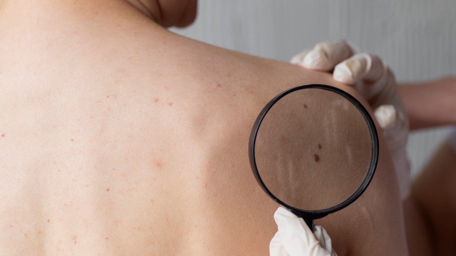 Methods of Mole Removal by a Dermatologist