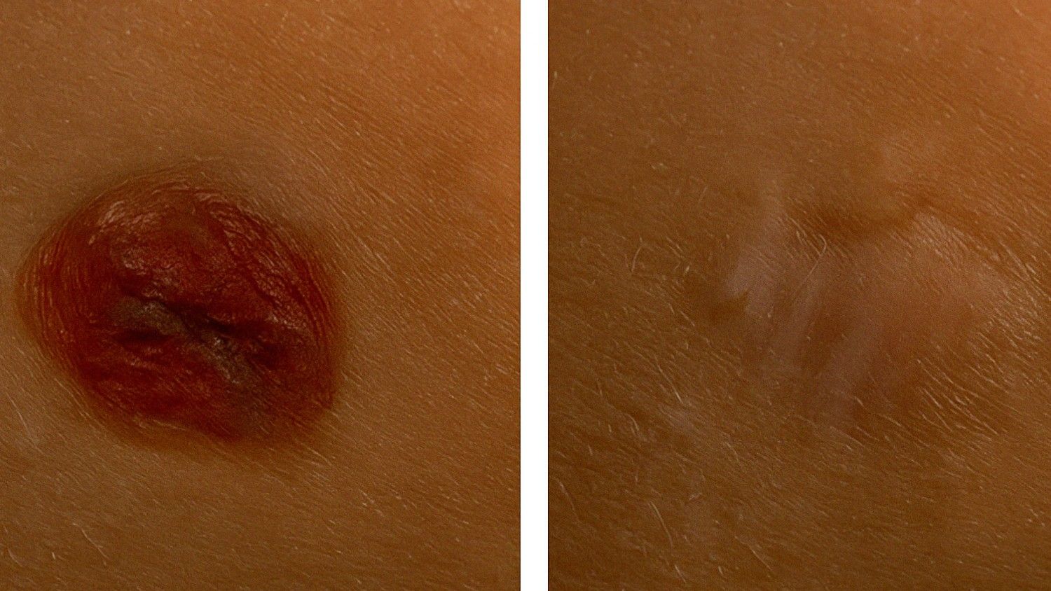 Potential for Scarring