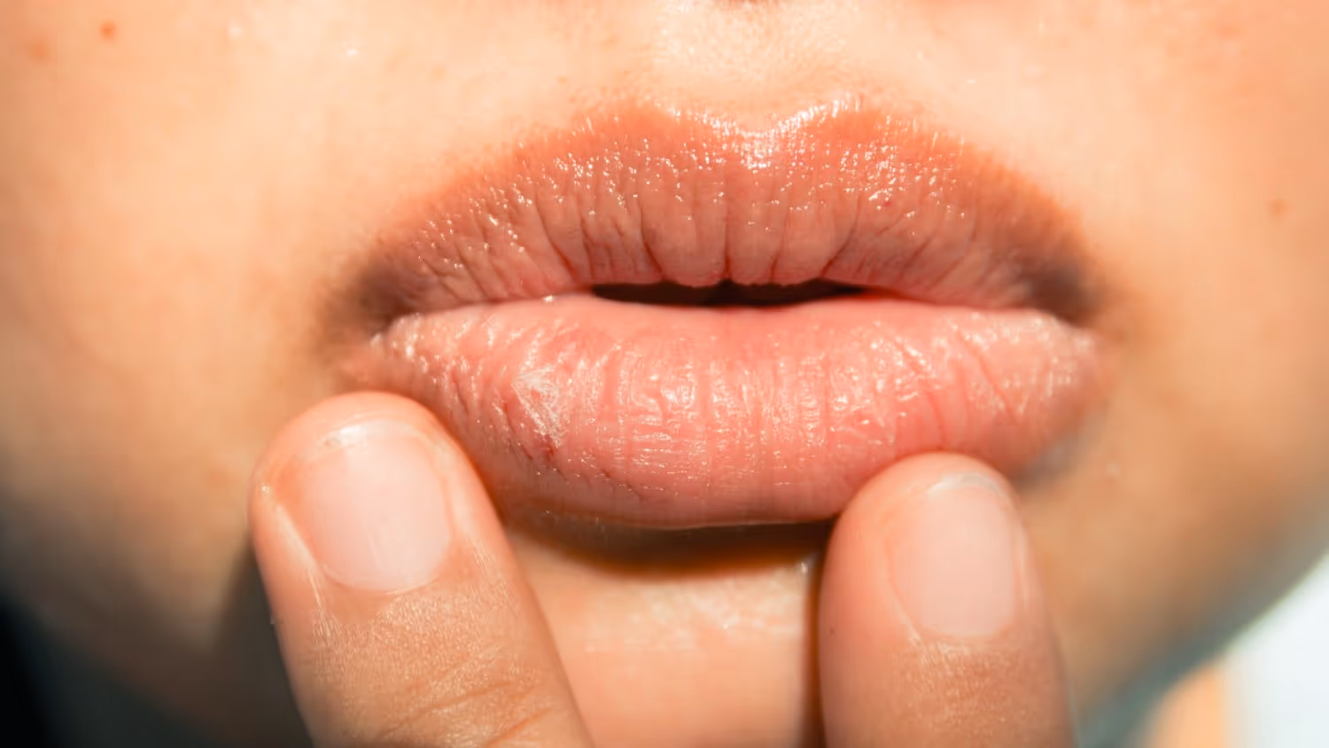 Sun Exposure and UV Damage