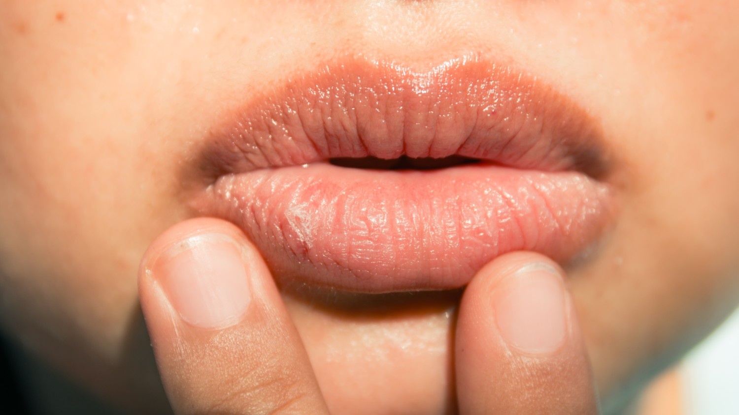 Sun Exposure and UV Damage