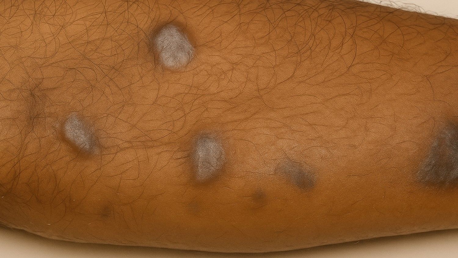 Symptoms of Lichen Planus Pigmentosus