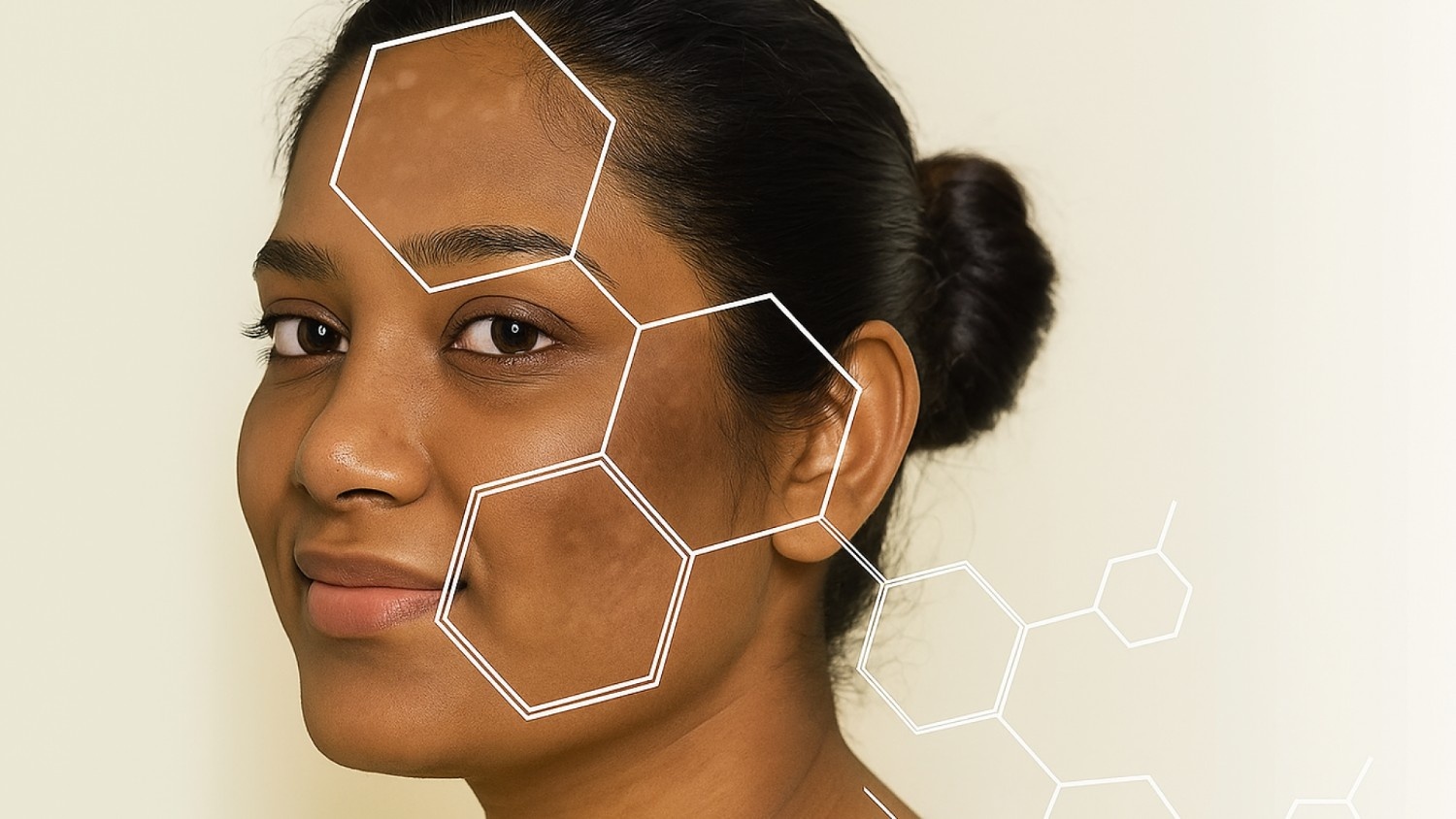 Common Types of Melasma
