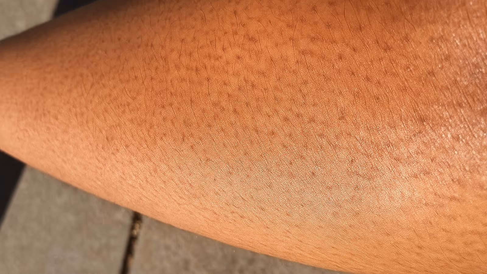 What Is Strawberry Skin?