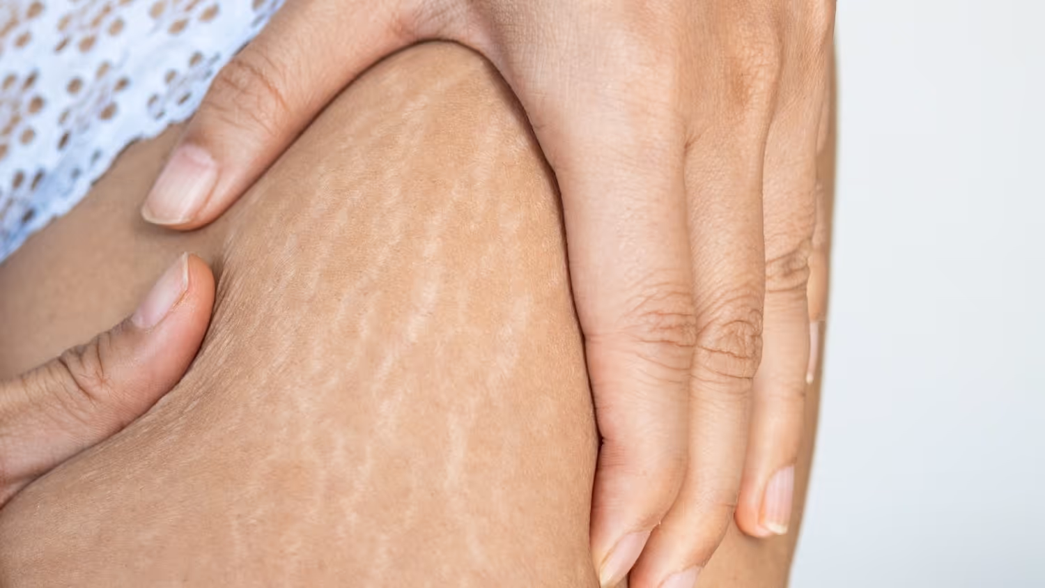 Understanding Stretch Marks
