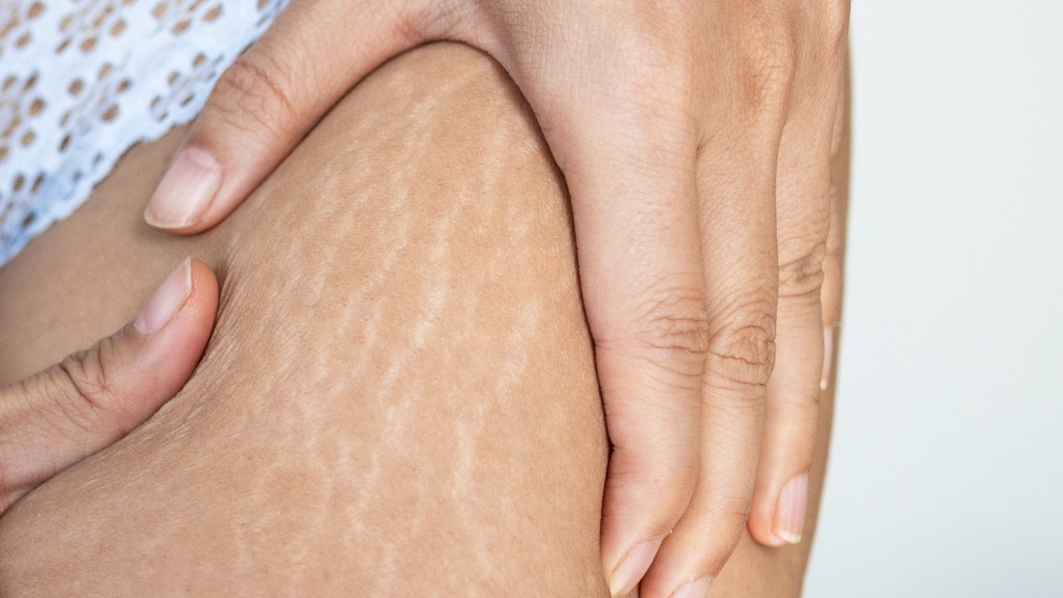 Understanding Stretch Marks