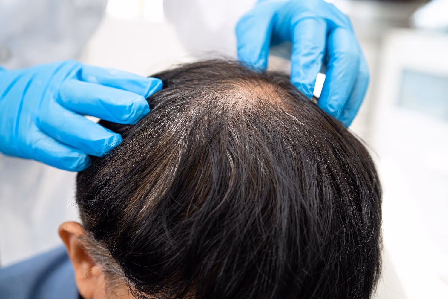 Professional Diagnosis - How Dermatologists Assess Hair Loss