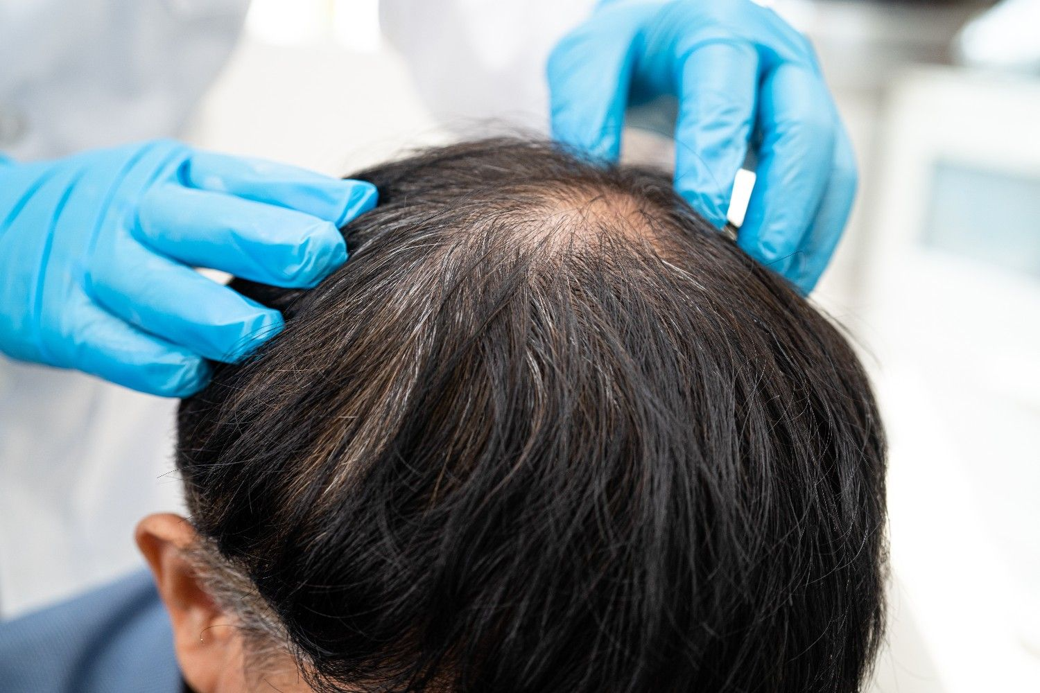 Professional Diagnosis - How Dermatologists Assess Hair Loss