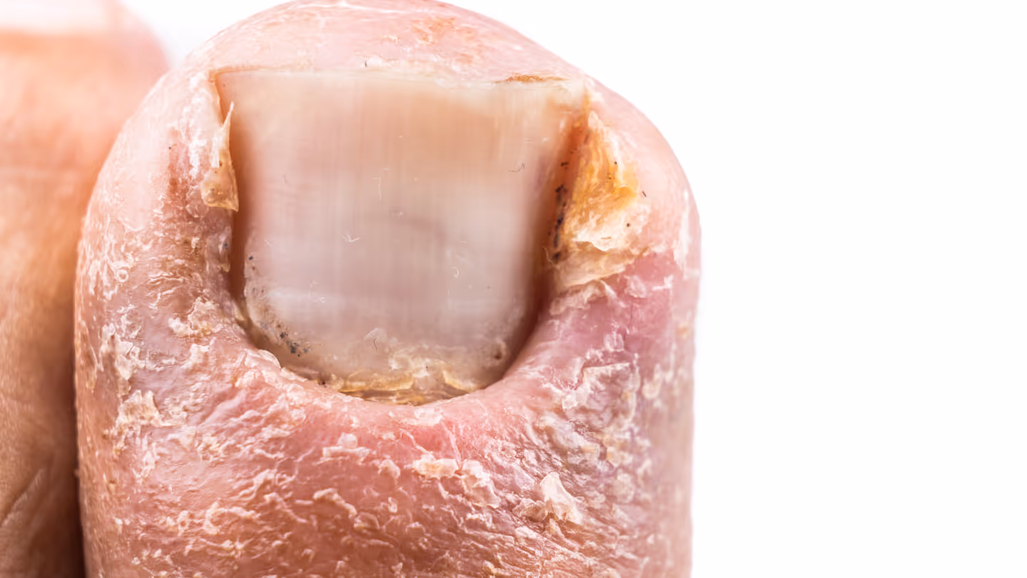 What is a Fungal Nail Infection?