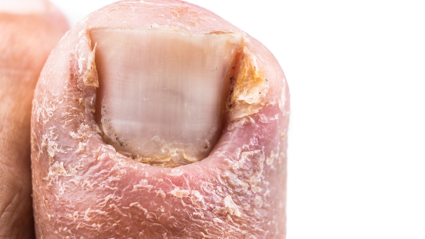 What is a Fungal Nail Infection?