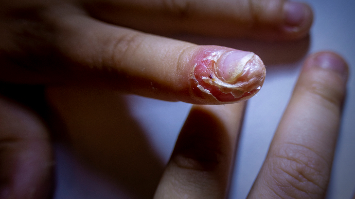 Causes and Risk Factors for Fungal Nail Infection