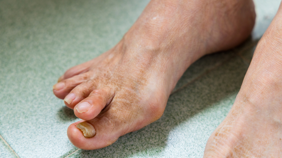 Treatment Options for Fungal Nail Infections