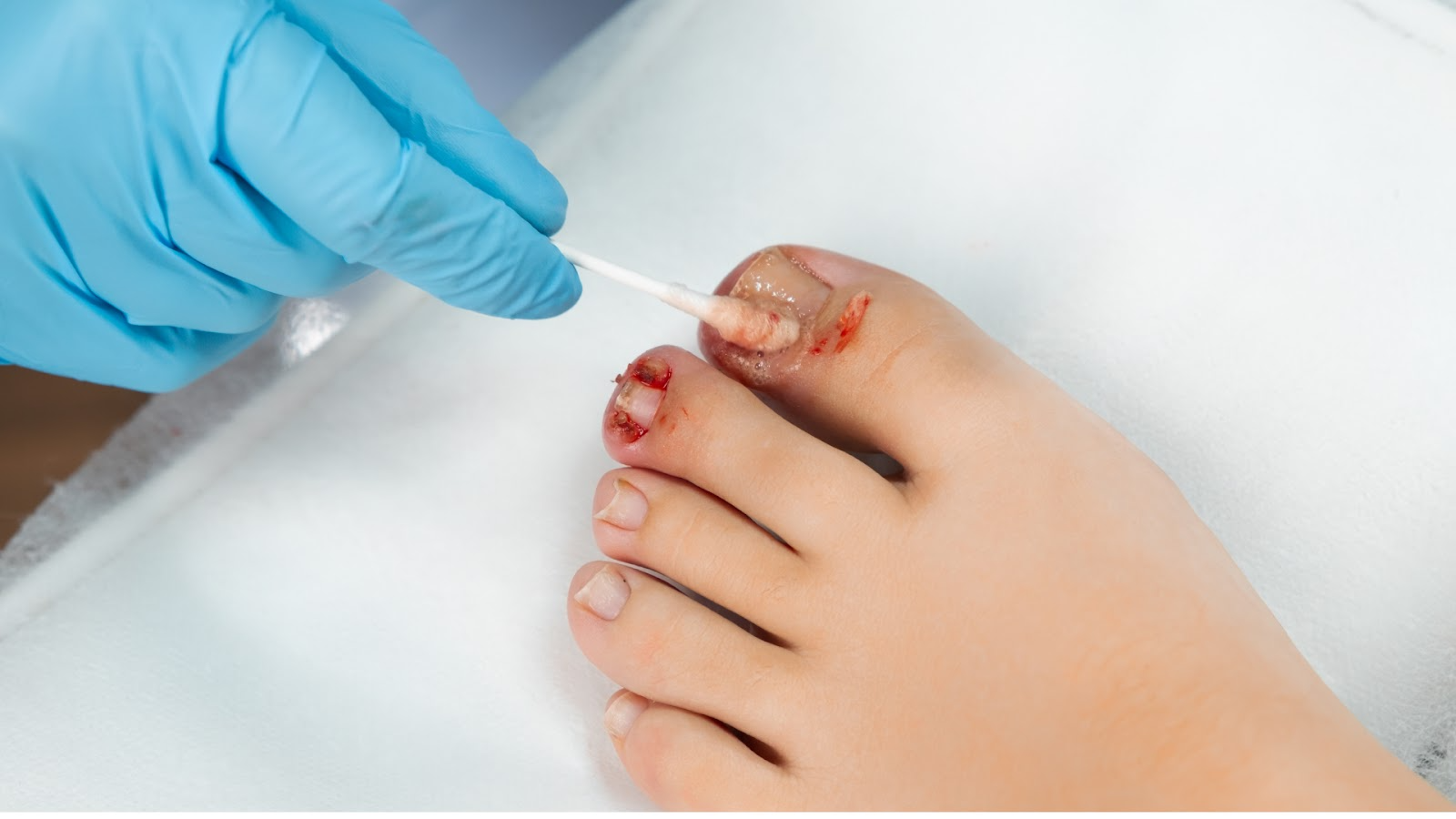 How is Fungal Nail Infection Diagnosed?