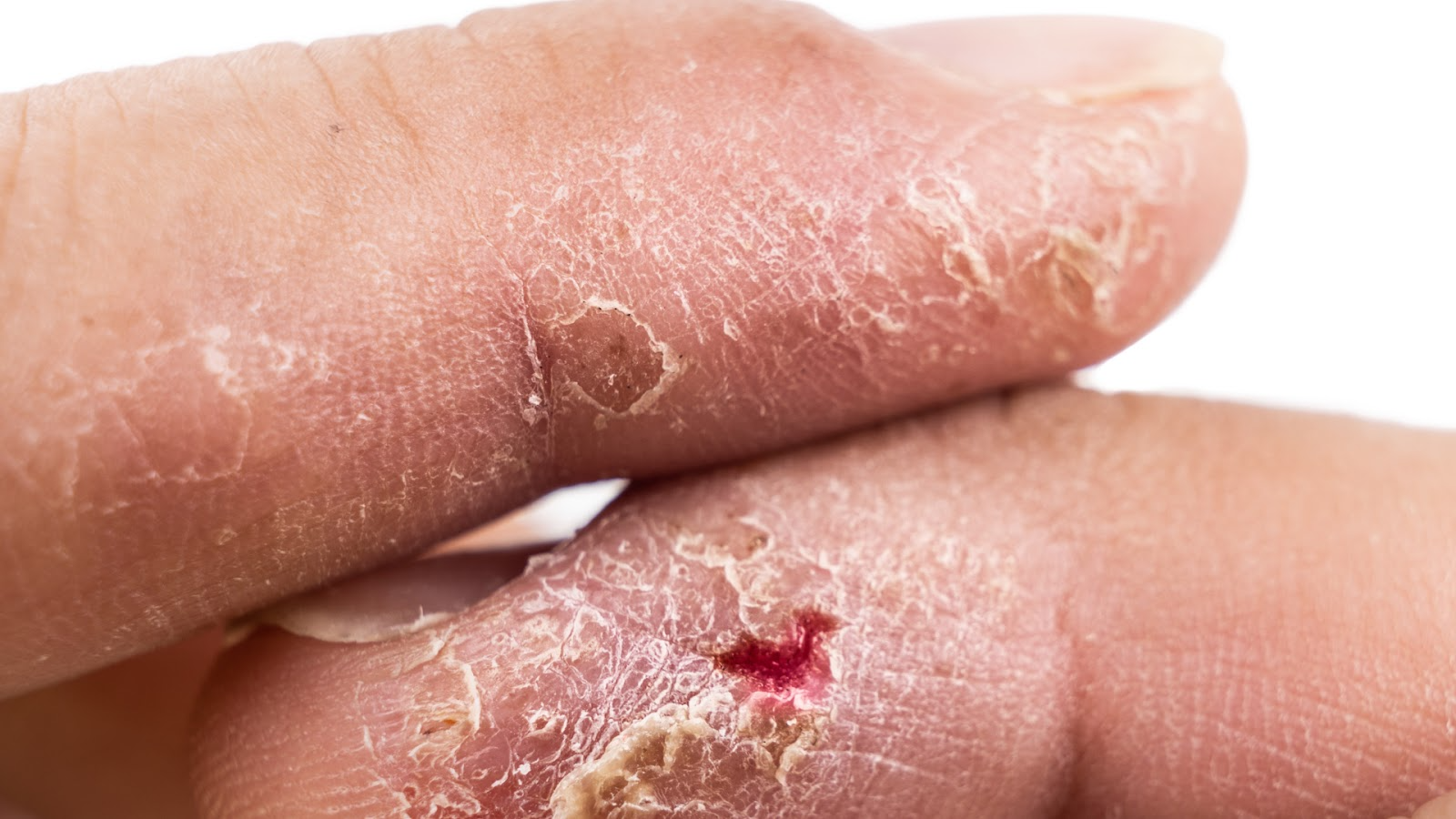 Preventing and Managing Fungal Nail Infections: The Importance of Timely Treatment and Intervention