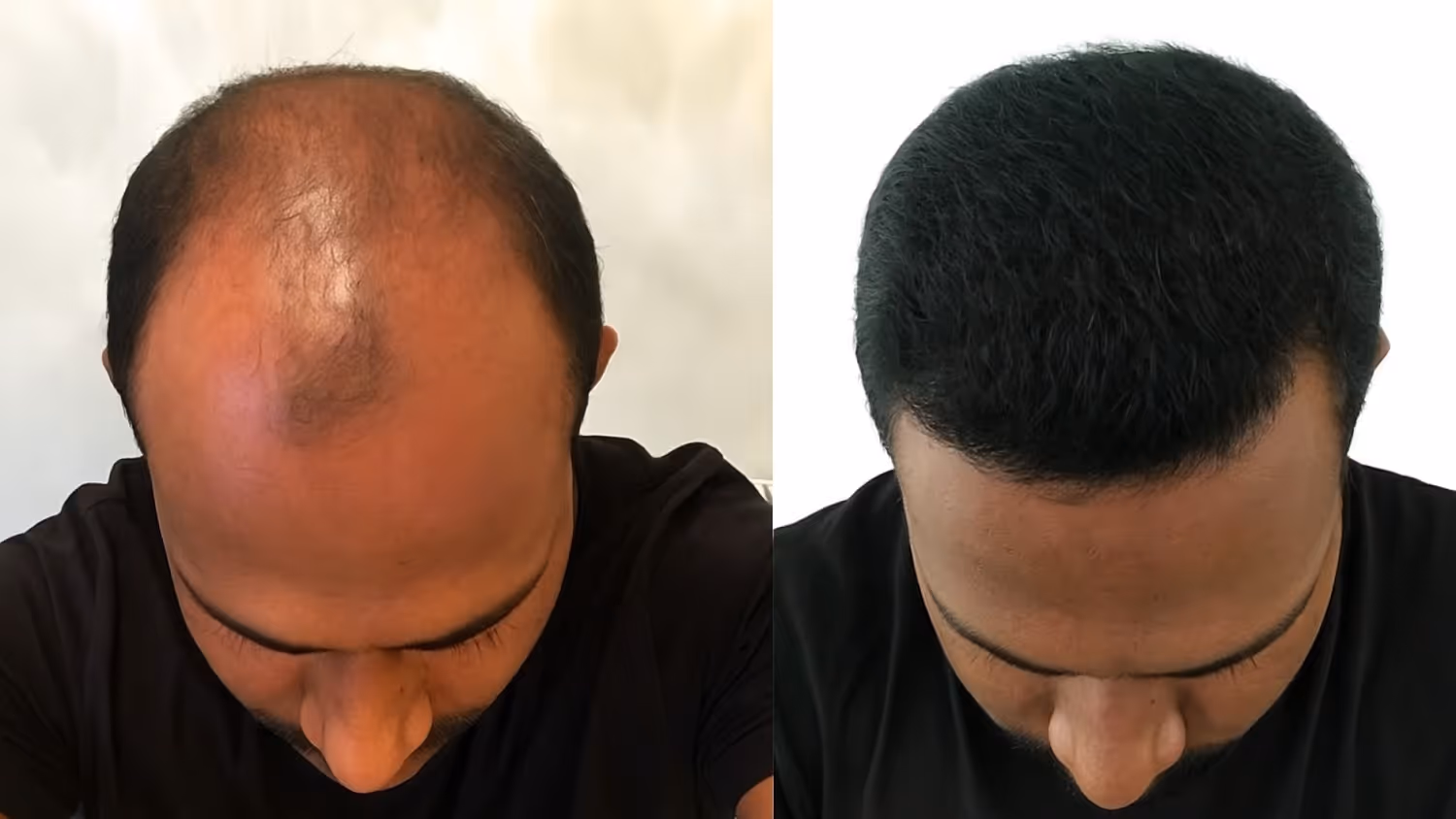 Benefits of PRP Treatment