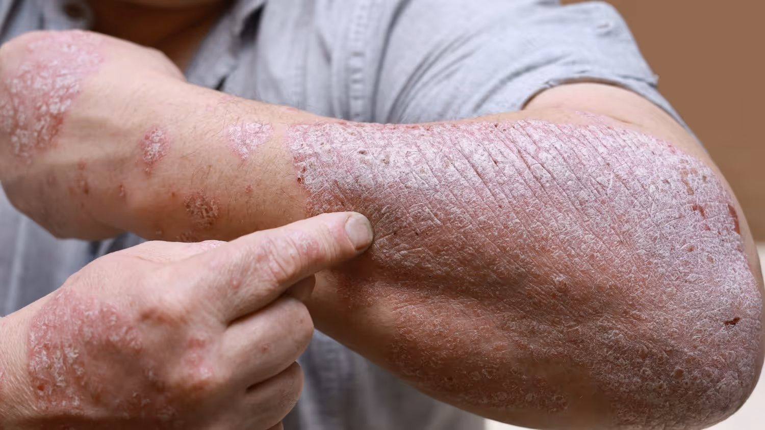 Diagnosis of Psoriasis