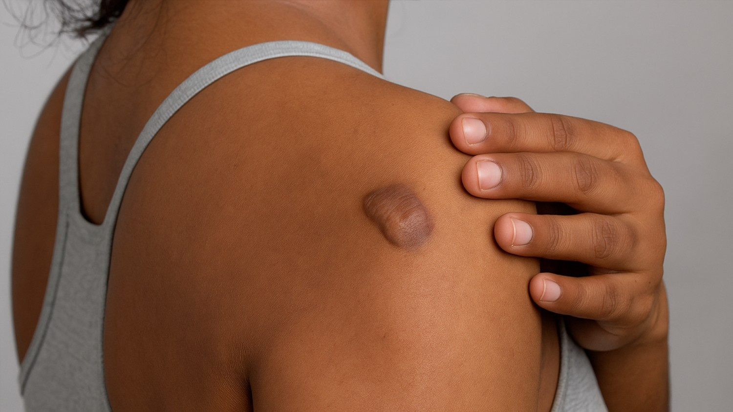 What are Keloid Scars?