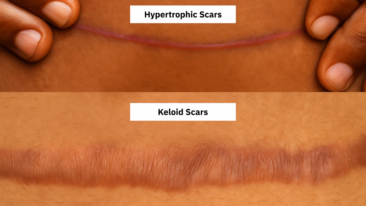 Differences Between Keloids and Hypertrophic Scars
