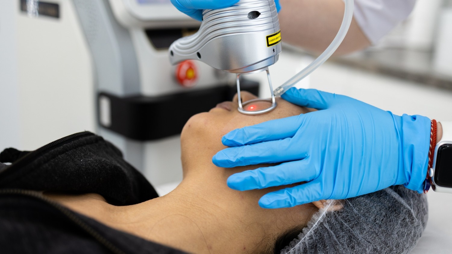 Key Benefits of Laser Skin Treatments
