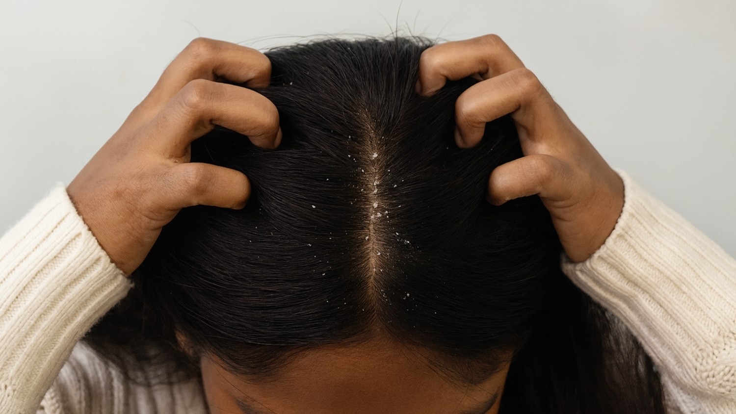 10 Best Dandruff Treatment Clinics in Chennai