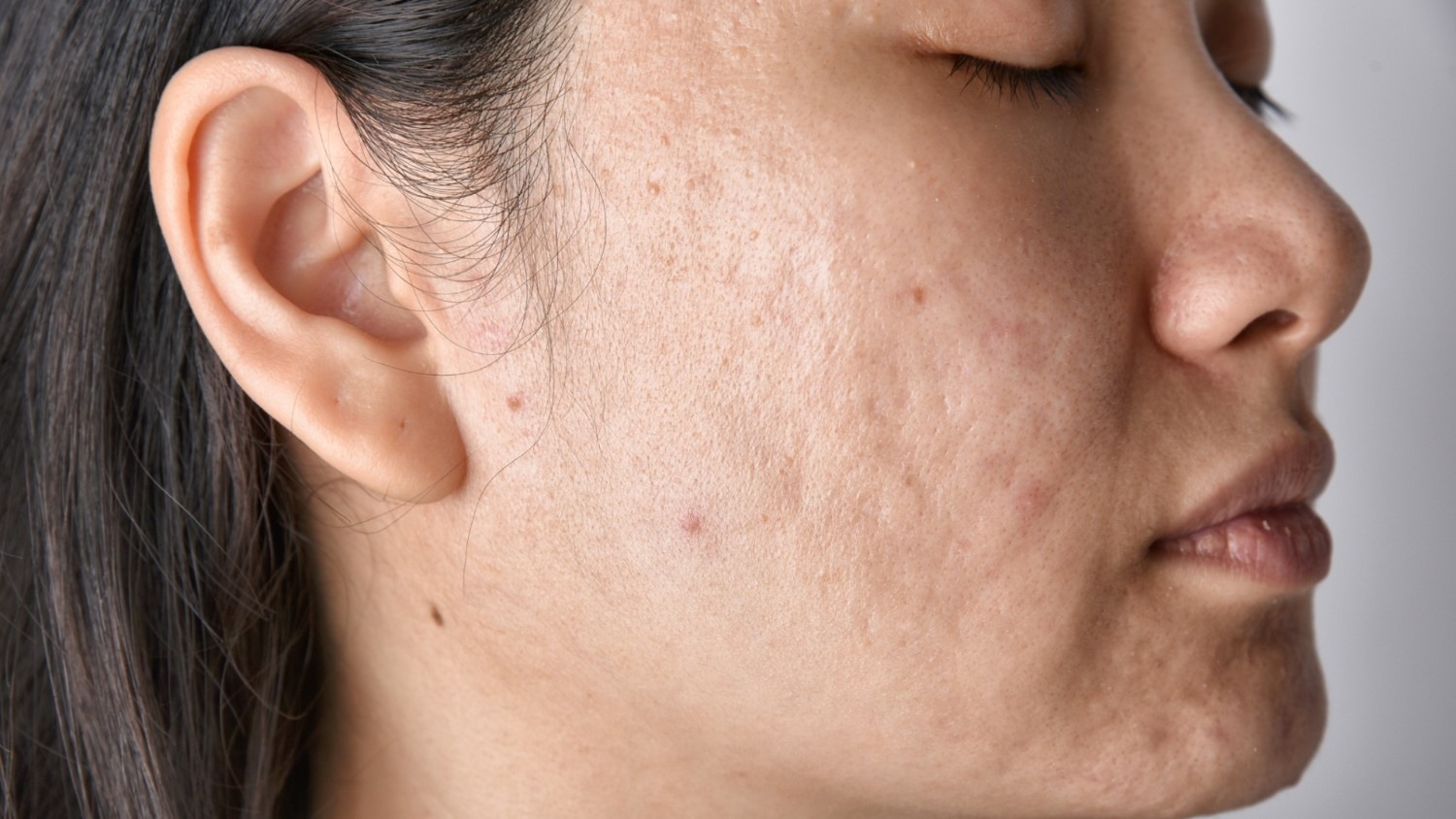 Acne and Acne Scarring