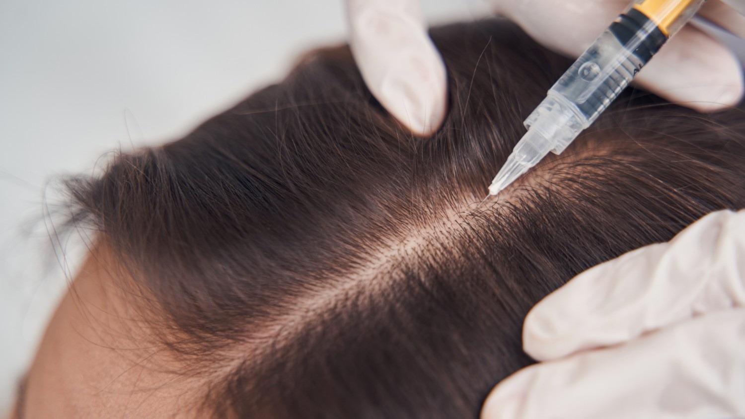 How to Choose the Right PRP Clinic in Padur (Practical Checklist)