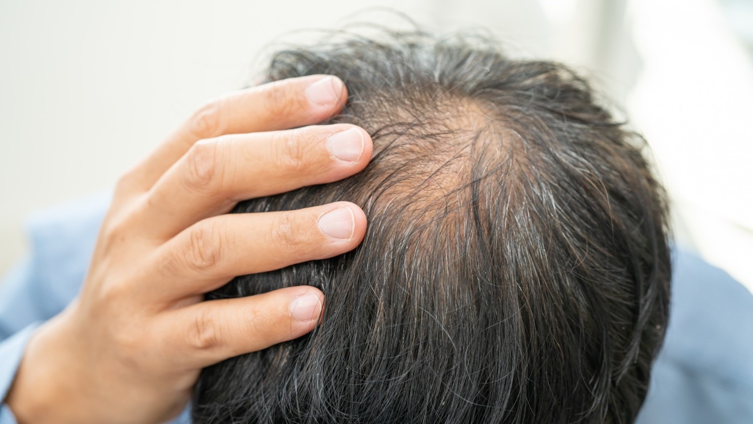 5 Common Causes of Hair Loss and When PRP Is Most Effective