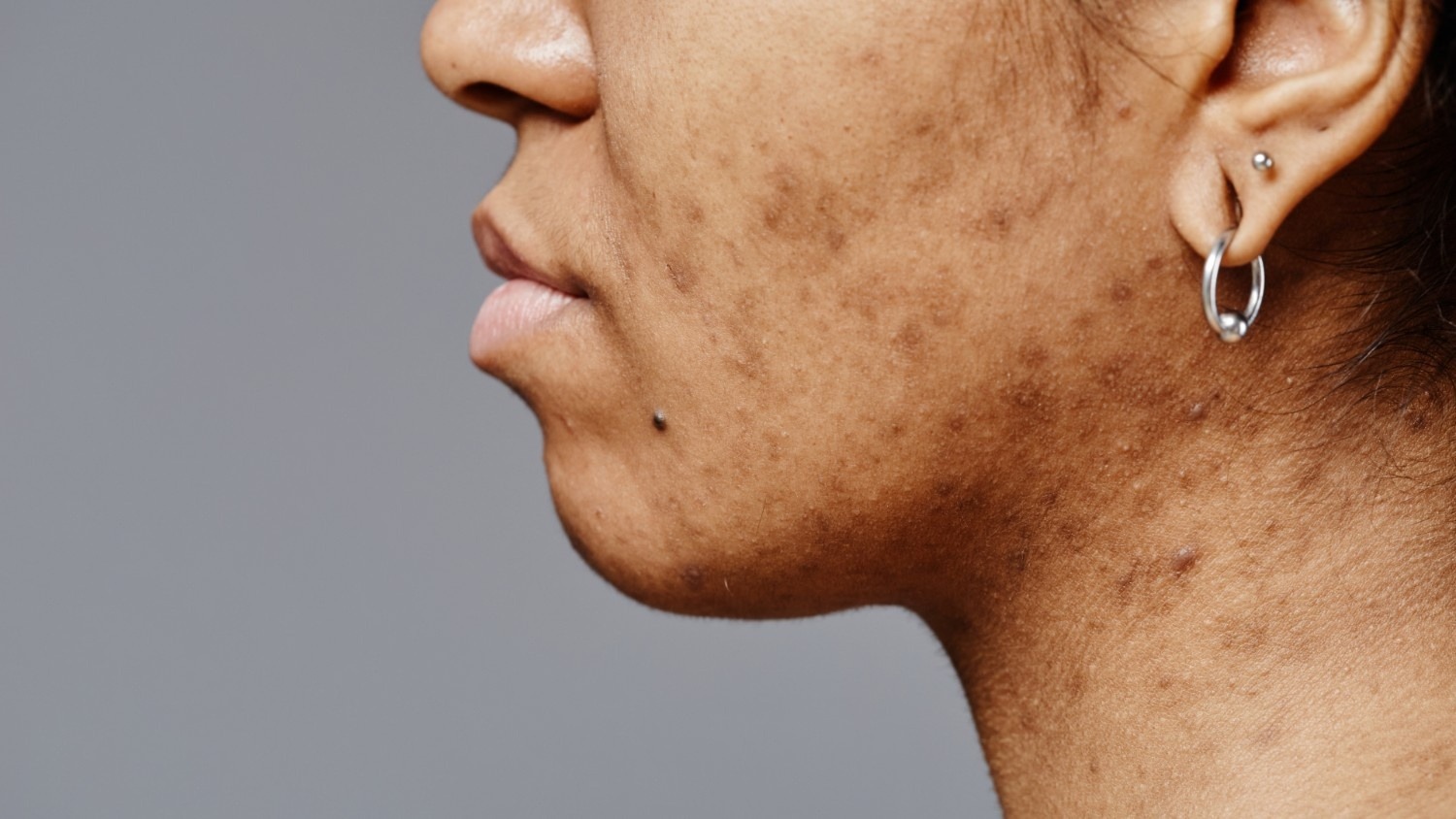 Pigmentation Concerns (Sunspots and Age Spots)